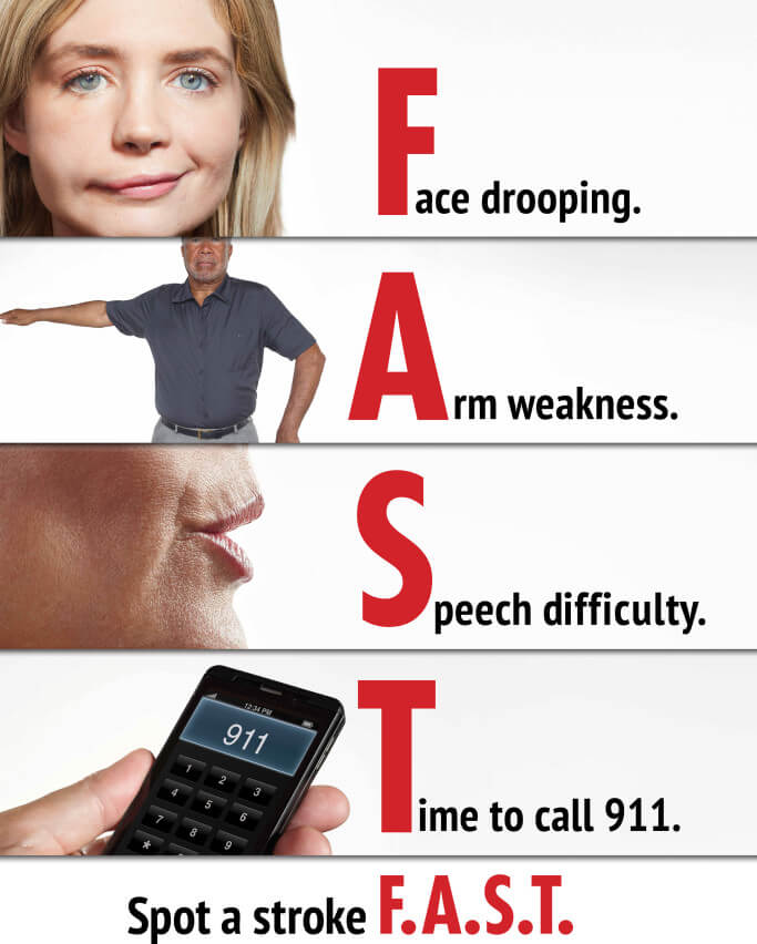 Stroke - FAST